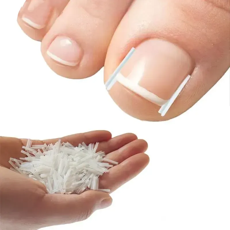 Professional ingrown toenail treatment tool correcting and straightening ingrown nails for pain relief.